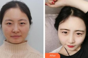 深圳?，斄猪槼毖劭漆t(yī)院肖月影整形價格表附眼部修復(fù)案例展示