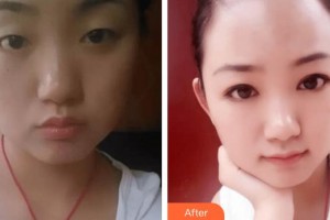 深圳愛爾眼科醫(yī)院邵嵐整形價格表附切開雙眼皮案例展示