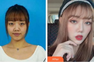 深圳希瑪林順潮眼科醫(yī)院卡博整形價格表附內(nèi)切祛眼袋案例展示