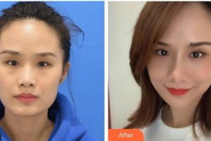 深圳?，斄猪槼毖劭漆t(yī)院萬竹整形價格表附激光去眼袋案例展示