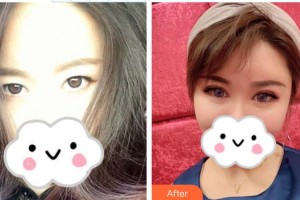 深圳?，斄猪槼毖劭漆t(yī)院劉泉整形價格表附眼部綜合案例展示