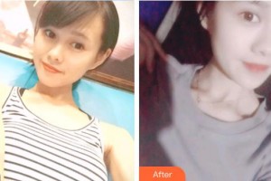 深圳?，斄猪槼毖劭漆t(yī)院孫紅整形價格表附切開雙眼皮案例展示