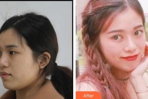 深圳希瑪林順潮眼科醫(yī)院尉洋整形價格表附眼部綜合案例展示