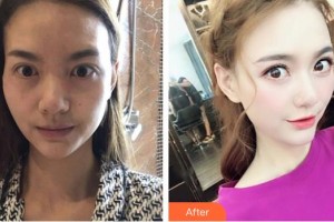 深圳希瑪林順潮眼科醫(yī)院袁野整形價格表附眼部修復案例展示