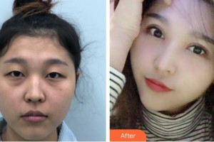 深圳?，斄猪槼毖劭漆t(yī)院林小銘整形價格表附眼部綜合案例展示