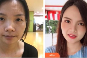 深圳希瑪林順潮眼科醫(yī)院舒敏整形價格表附切開雙眼皮案例展示