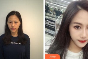 深圳?，斄猪槼毖劭漆t(yī)院石峰整形價格表附眼部修復案例展示