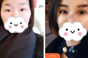 深圳?，斄猪槼毖劭漆t(yī)院范偉整形價格表附眼部綜合案例展示