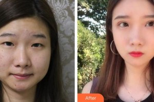 深圳?，斄猪槼毖劭漆t(yī)院林妙麗整形價格表附眼部整形雙眼皮案例展示