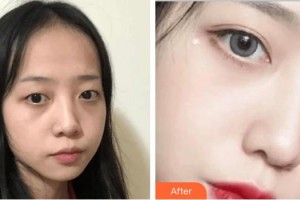 深圳華夏眼科醫(yī)院李春燕整形價格表附內(nèi)切祛眼袋案例展示