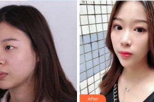 深圳華夏眼科醫(yī)院吳銳鋒整形價格表附外切祛眼袋案例展示