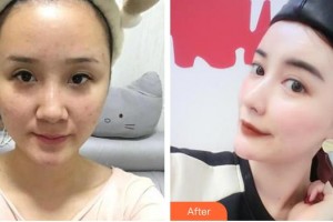 懷化市第一人民醫(yī)院史萍整形價格表附鼻部綜合案例展示