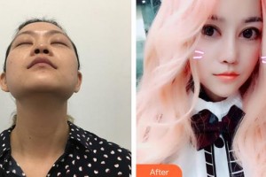 懷化市第一人民醫(yī)院李鐵華整形價格表附鼻部綜合案例展示