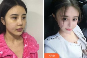 懷化市第一人民醫(yī)院張繼揚整形價格表附鼻部綜合案例展示