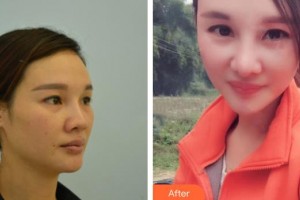 懷化市第一人民醫(yī)院易斌整形價格表附鼻部綜合案例展示