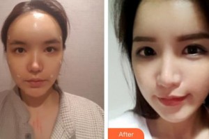 懷化市第一人民醫(yī)院于蘭整形價格表附鼻部綜合案例展示