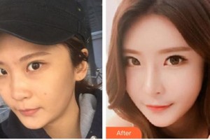 東莞王曉杰醫(yī)療美容診所王曉杰整形價(jià)格表附鼻部綜合案例展示