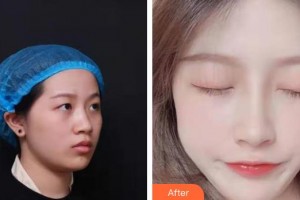 東莞百佳瑪麗亞婦產(chǎn)醫(yī)院金哉勛整形價(jià)格表附鼻部綜合案例展示