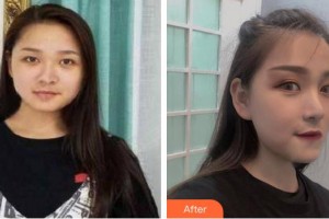 東莞美立方美容醫(yī)院張志勇整形價(jià)格表附鼻部綜合案例展示