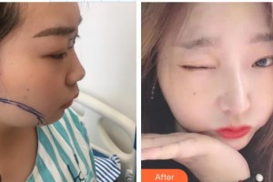 東莞韓美整形醫(yī)院黃中志整形價(jià)格表附膨體隆鼻案例展示