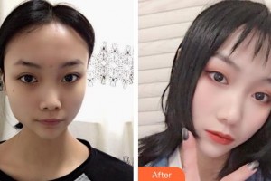 東莞華美醫(yī)療美容醫(yī)院郭思婷整形價(jià)格表附鼻部綜合案例展示