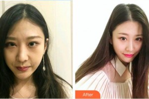 東莞維多利亞整形醫(yī)院周俊整形價(jià)格表附鼻部綜合案例展示