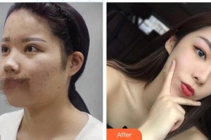 東莞華美醫(yī)療美容醫(yī)院邵天如整形價(jià)格表附鼻部綜合案例展示