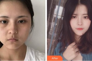 東莞同濟(jì)光華醫(yī)院口腔科楊茂整形價(jià)格表附鼻部綜合例展示