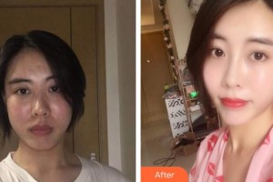 東莞韓美整形醫(yī)院唐可整形價(jià)格表附鼻部綜合案例展示