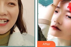 東莞環(huán)球美天醫(yī)療美容門診部宋亞整形價(jià)格表附隱形托槽矯正案例展示