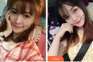 東莞美立方美容醫(yī)院肖玉珠整形價(jià)格表附眼部綜合案例展示