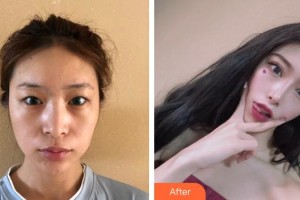 東莞華廈眼科醫(yī)院袁進(jìn)整形價(jià)格表附眼部綜合案例展示