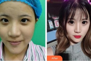 東莞愛爾眼科醫(yī)院扶城賓整形價(jià)格表附切開雙眼皮案例展示