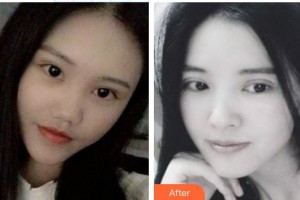 東莞愛爾眼科醫(yī)院陳曉蓓整形價(jià)格表附激光去眼袋案例展示