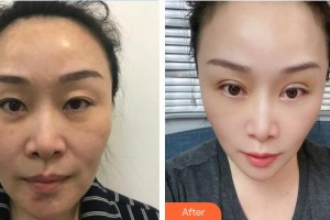 東莞光明眼科醫(yī)院戴玲整形價(jià)格表附眼部整形案例展示