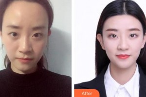 東莞華廈眼科醫(yī)院姚立平整形價(jià)格表附埋線雙眼皮案例展示