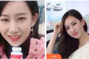 東莞南城固德口腔門診部黃城整形價格表附牙齒隱形矯正案例展示