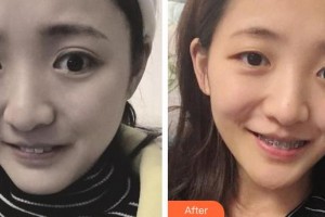 東莞拜爾口腔門診部張苑芳整形價格表附金屬托槽矯正案例展示