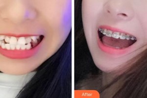 東莞拜爾口腔門診部李銳景整形價格表附牙齒隱形矯正案例展示