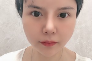 上海愉悅美聯(lián)臣醫(yī)院顴骨貴嗎果好不好附案例