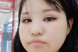 上海時(shí)光整形外科醫(yī)院下頜角手術(shù)果太好了