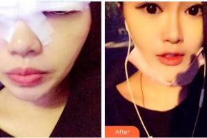 景德鎮(zhèn)市醫(yī)院賀恒偉整形價格表附眼部綜合案例展示