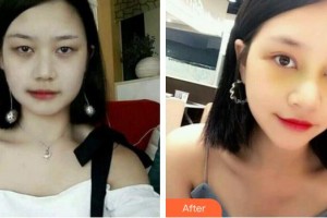 景德鎮(zhèn)亞菲整形美容醫(yī)院李澤偉整形價(jià)格表附埋線雙眼皮案例展示