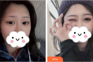 景德鎮(zhèn)市第一人民醫(yī)院美容整形外科何平整形價(jià)格表附眼部綜合案例展示