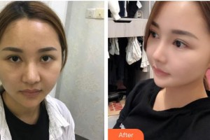 潮州博蘭雅醫(yī)療美容門診部茍上財整形價格表附墊鼻基底案例展示