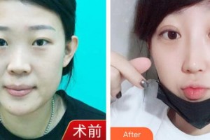 潮州博蘭雅醫(yī)療美容門診部劉惠珊整形價格表附鼻部綜合案例展示