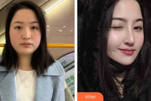 潮州華美醫(yī)療美容門診部林康維整形價格表附鼻部綜合案例展示