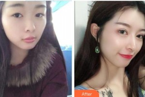 慈溪圣愛醫(yī)院整形美容科鄭聰聰整形價格表附鼻部綜合案例展示