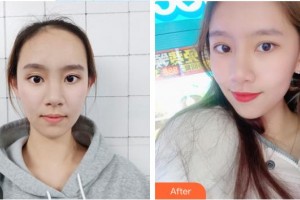 慈溪悅爾醫(yī)學(xué)美容醫(yī)院卜雙燕整形價格表附鼻部綜合案例展示