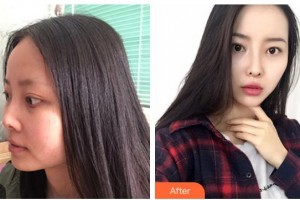 慈溪悅爾醫(yī)學(xué)美容醫(yī)院賈晶整形價格表附鼻部綜合案例展示